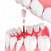 видове зъбни импланти - 99061 новини