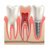 видове зъбни импланти - 62825 комбинации