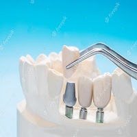 видове зъбни импланти - 45514 селекции