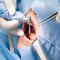видове зъбни импланти - 82403 отстъпки