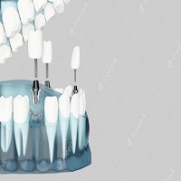 видове зъбни импланти - 88054 разновидности