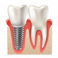 видове зъбни импланти - 29668 селекции