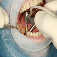 видове зъбни импланти - 20588 оферти