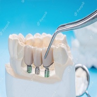 видове зъбни импланти - 84018 предложения
