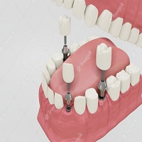 видове зъбни импланти - 37877 разновидности